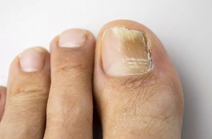 Mycosis nails in the legs