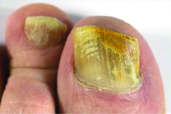 Nails in the legs