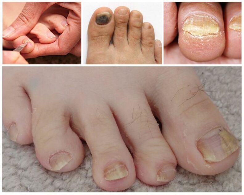 Symptoms of onychomycosis