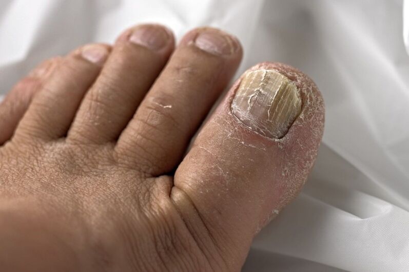 Toenail fungus